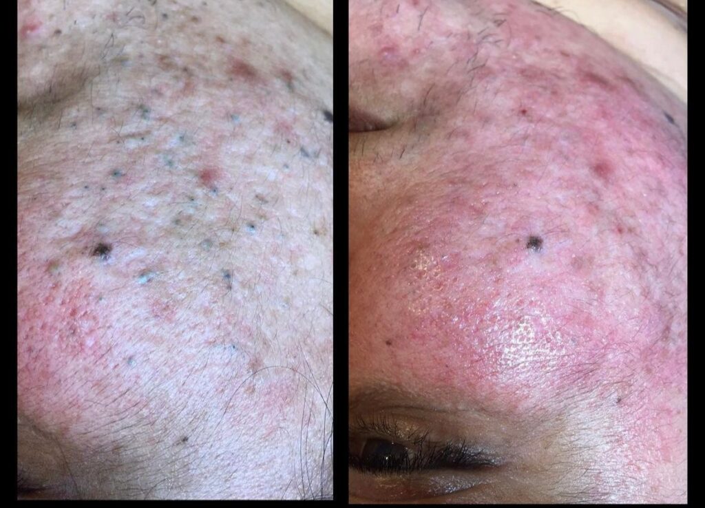 Microdermabrasion and manual extraction